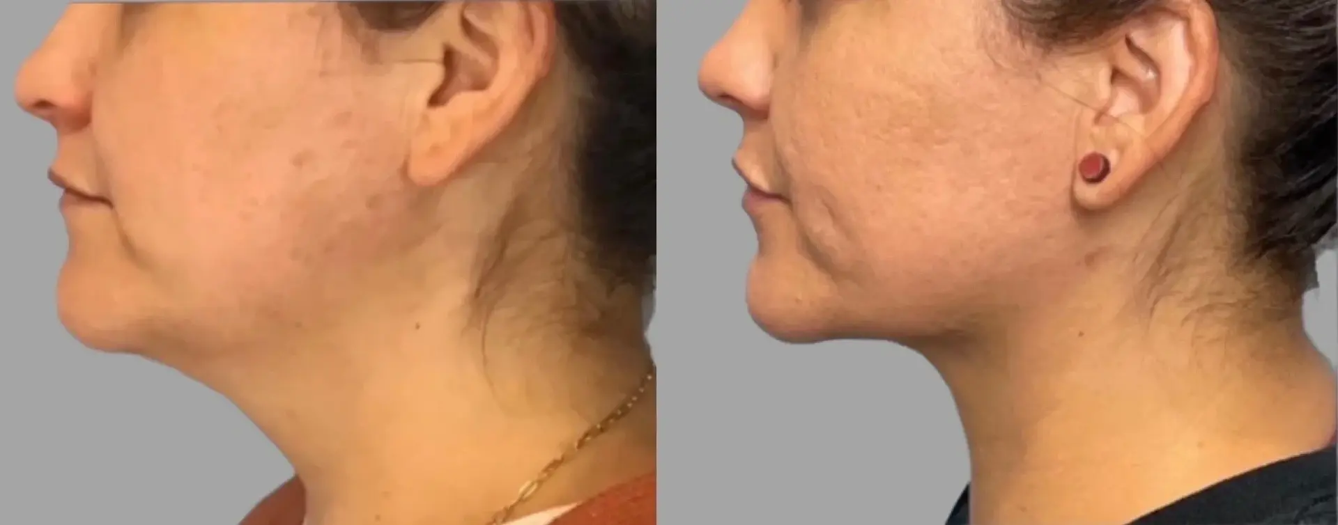 Pavlo Isak, MD submental liposuction result — Newport Beach, CA