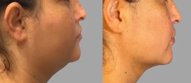 Neck Liposuction result at Pavlo Isak, MD in Newport Beach, CA