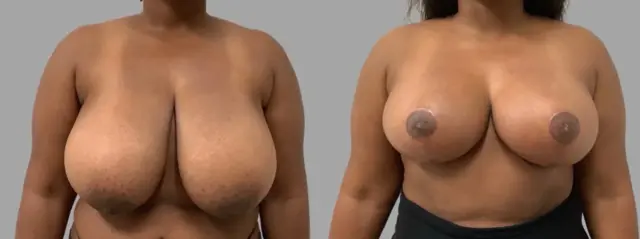 Breast Lift result at Pavlo Isak, MD in Newport Beach, CA