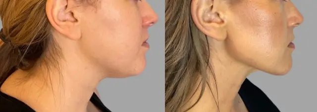 Neck Liposuction result at Pavlo Isak, MD in Newport Beach, CA
