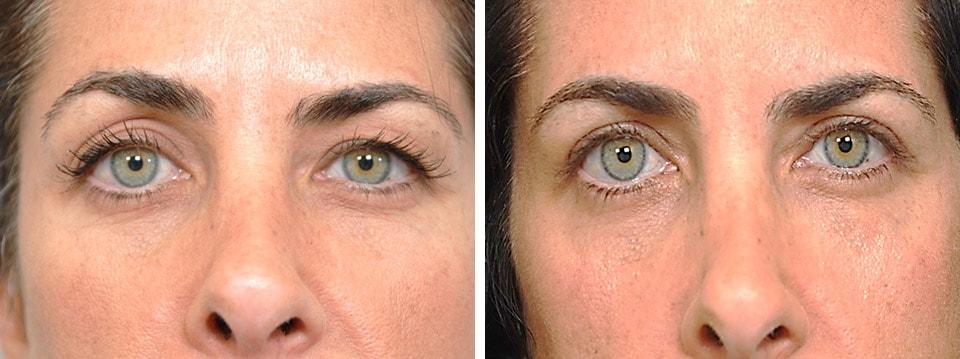 Jessica Lattman, MD eyelid lift result — New York, NY