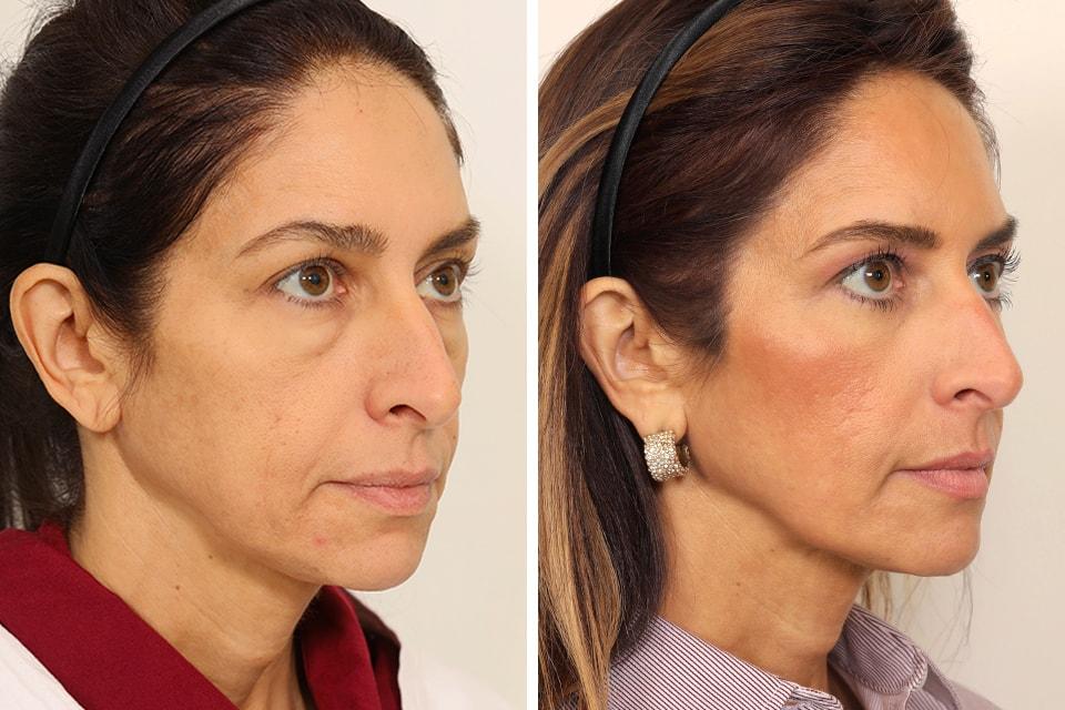 Jessica Lattman, MD eyelid lift result — New York, NY