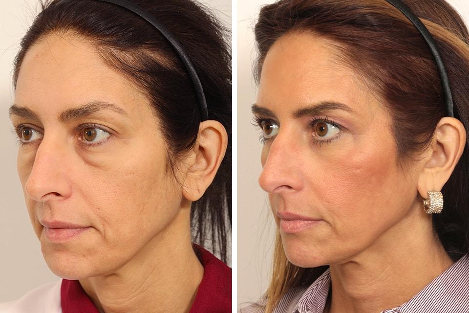 Jessica Lattman, MD eyelid lift result — New York, NY
