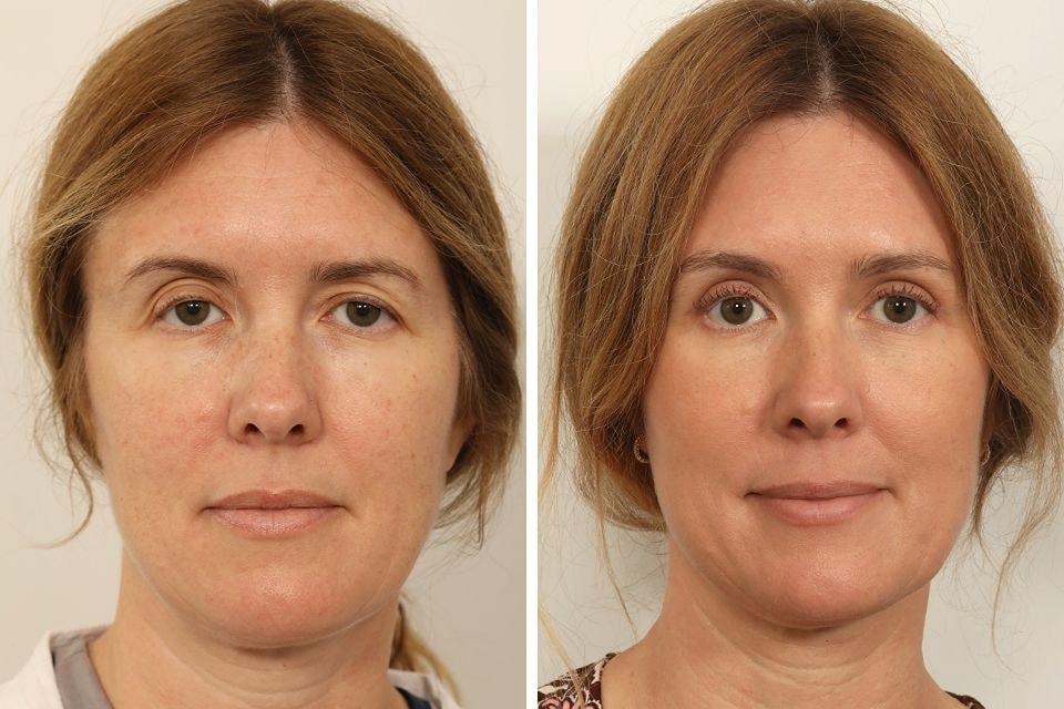 Jessica Lattman, MD brow lift result — New York, NY