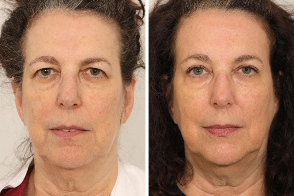 Jessica Lattman, MD brow lift result — New York, NY