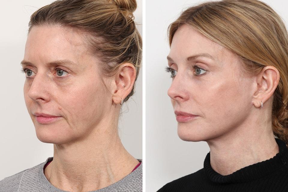 Jessica Lattman, MD eyelid lift result — New York, NY