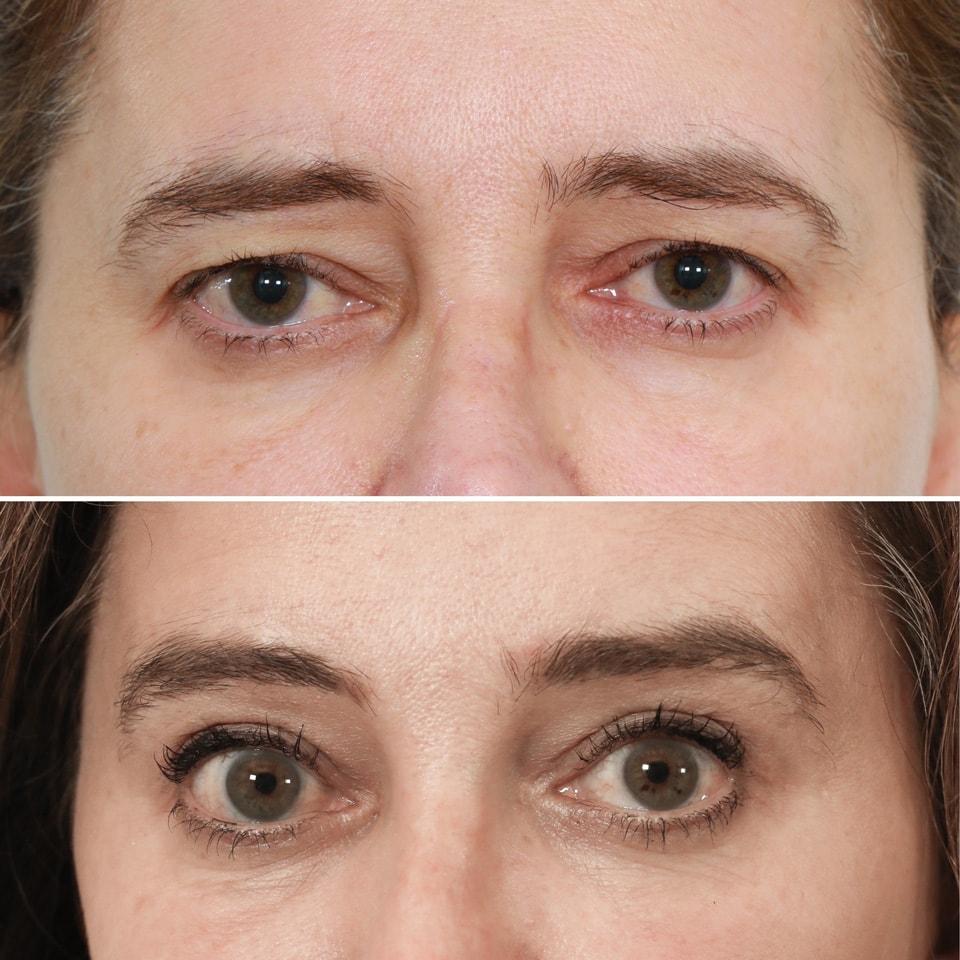 Jessica Lattman, MD brow lift result — New York, NY