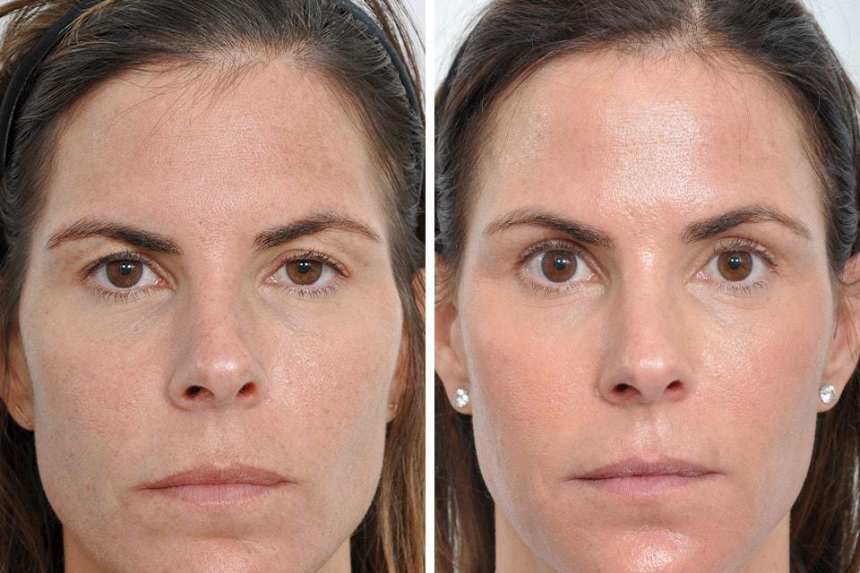 Jessica Lattman, MD brow lift result — New York, NY