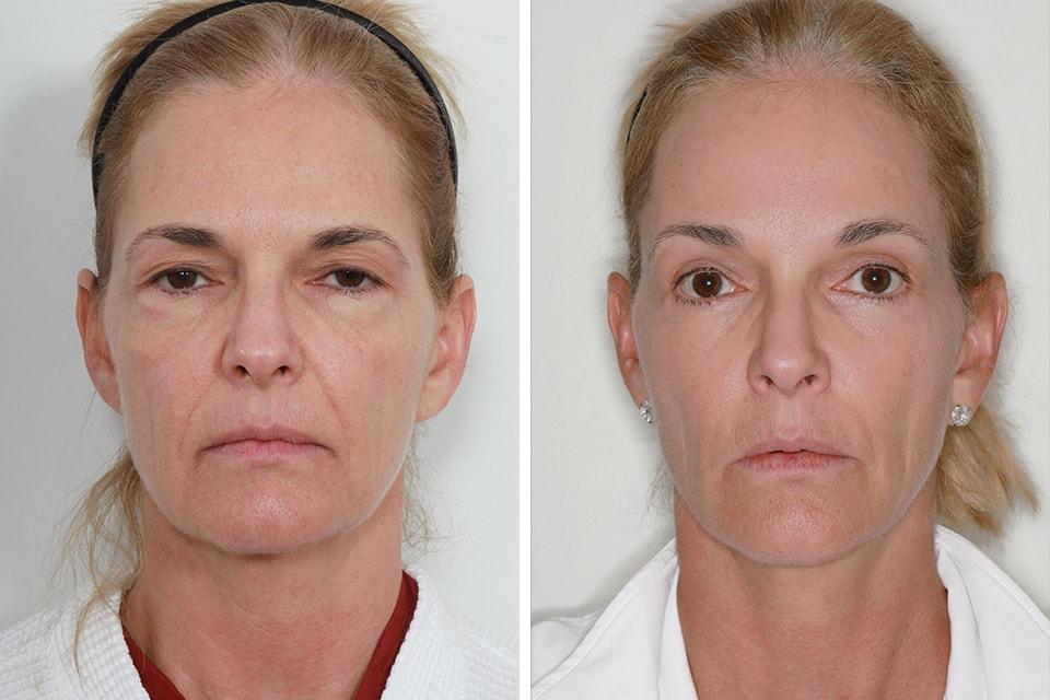 Jessica Lattman, MD brow lift result — New York, NY