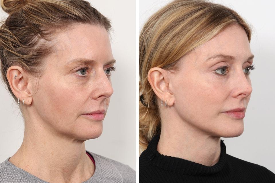 Jessica Lattman, MD eyelid lift result — New York, NY