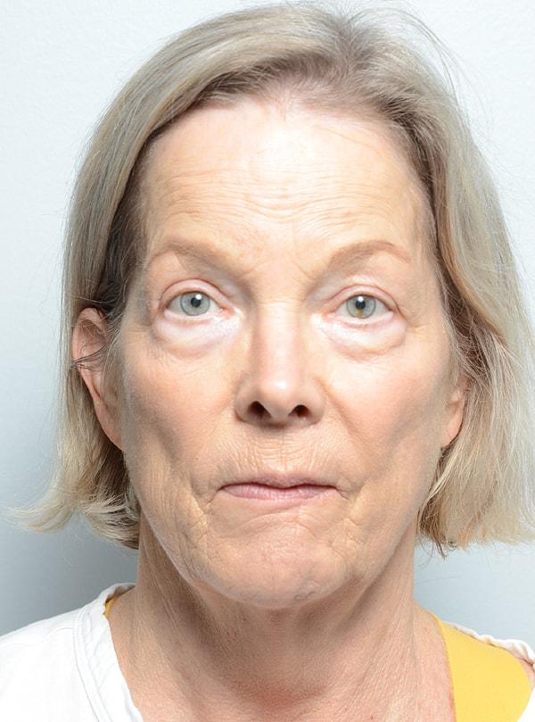 Sultan Facial Plastic and Reconstructive Surgery (Babar Sultan, MD) eyelid lift after — Towson, MD