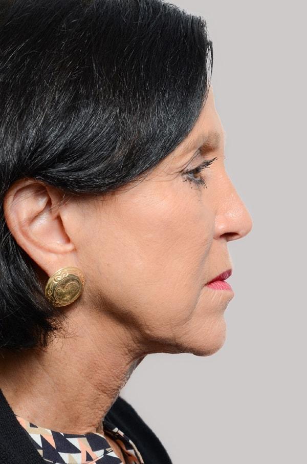 Sultan Facial Plastic and Reconstructive Surgery (Babar Sultan, MD) facelift after — Towson, MD