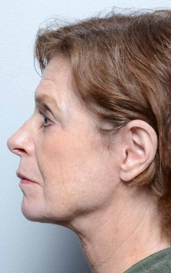 Sultan Facial Plastic and Reconstructive Surgery (Babar Sultan, MD) facelift after — Towson, MD