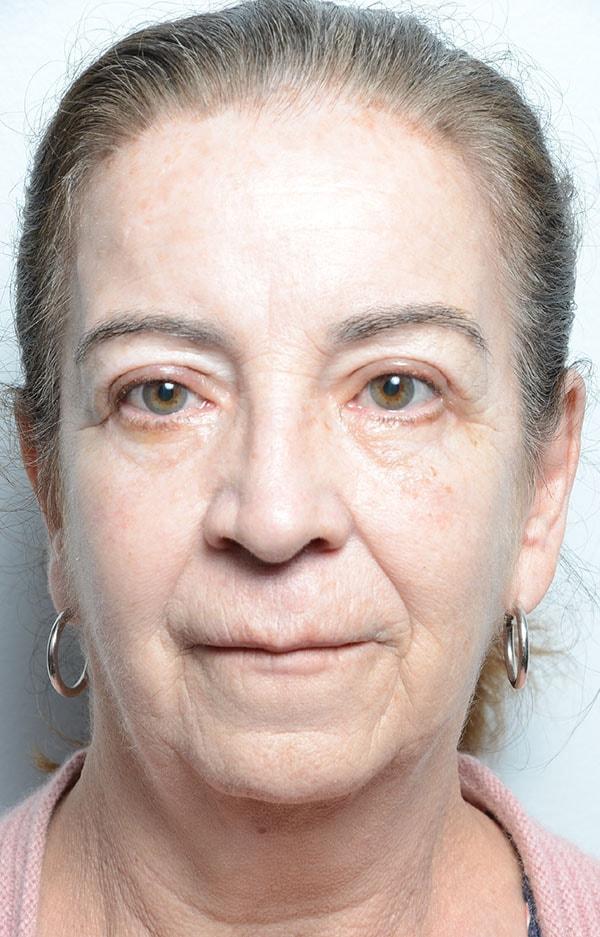 Sultan Facial Plastic and Reconstructive Surgery (Babar Sultan, MD) eyelid lift after — Towson, MD