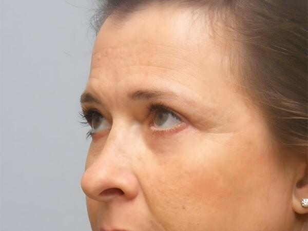 Georgetown Plastic Surgery eyelid lift after — Georgetown, TX
