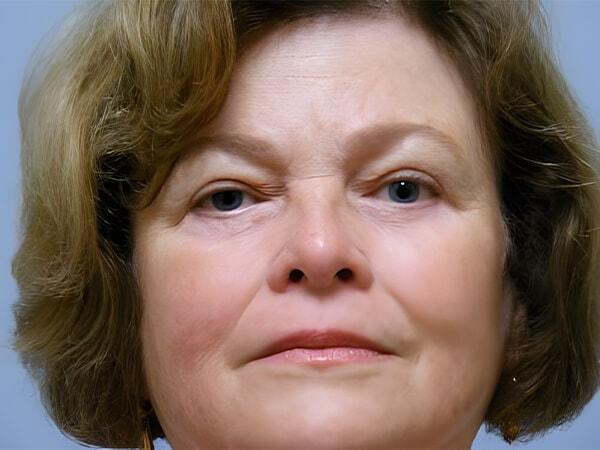 Georgetown Plastic Surgery eyelid lift after — Georgetown, TX