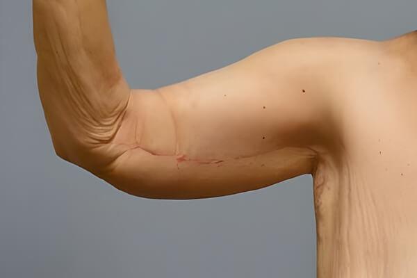 Arm Lift after at Georgetown Plastic Surgery in Georgetown, TX