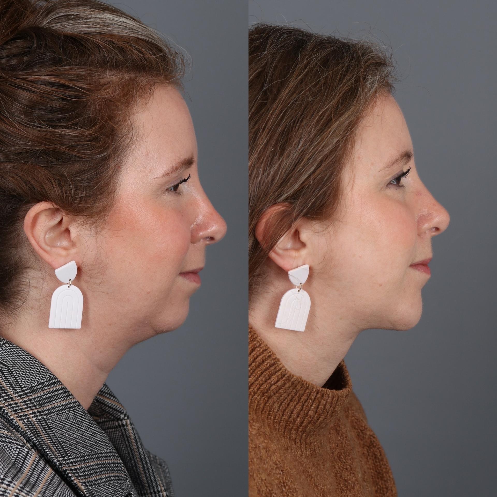 Portland Face Doctor (Peter Vila, MD) chin implant result — Tigard, OR