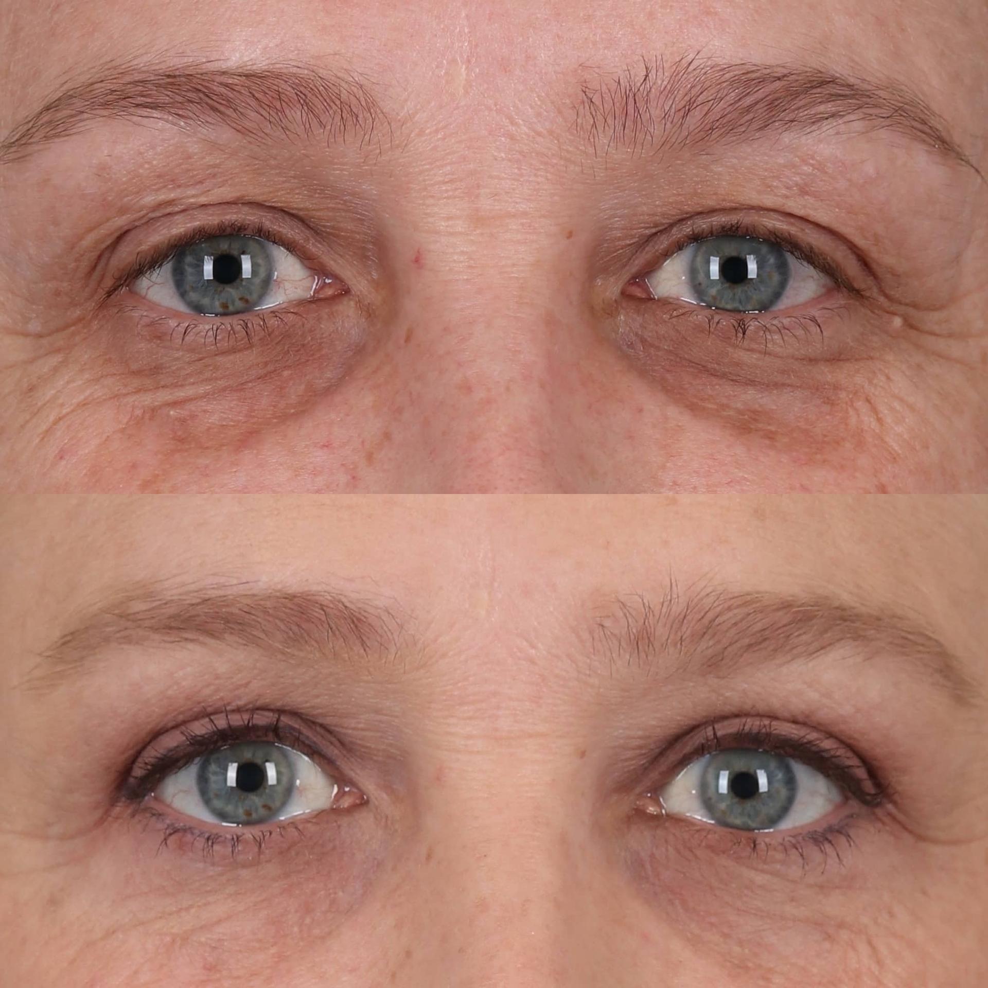Portland Face Doctor (Peter Vila, MD) eyelid lift result — Tigard, OR