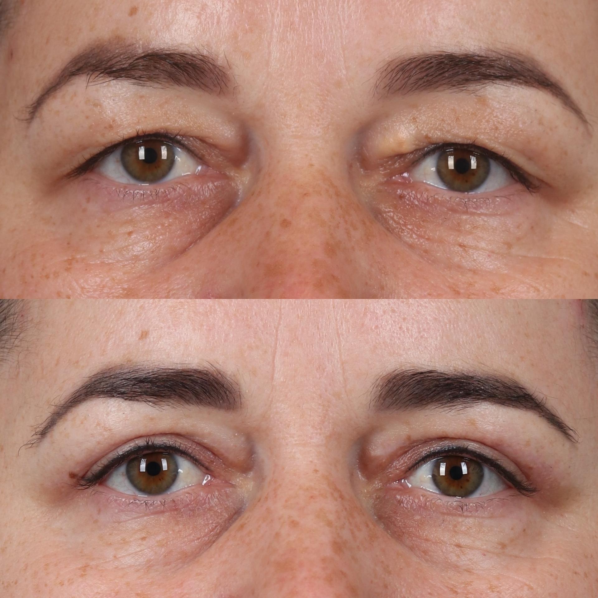Portland Face Doctor (Peter Vila, MD) eyelid lift result — Tigard, OR