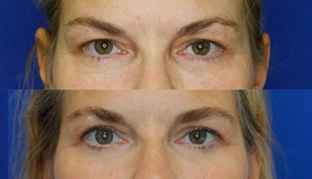 Portland Face Doctor (Peter Vila, MD) eyelid lift result — Tigard, OR