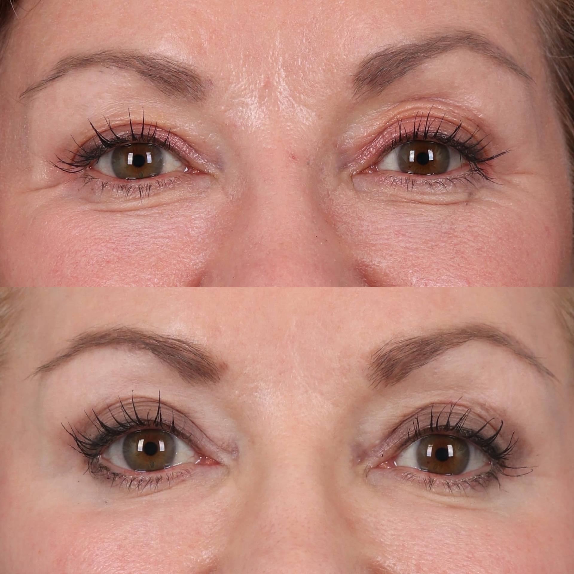 Portland Face Doctor (Peter Vila, MD) eyelid lift result — Tigard, OR