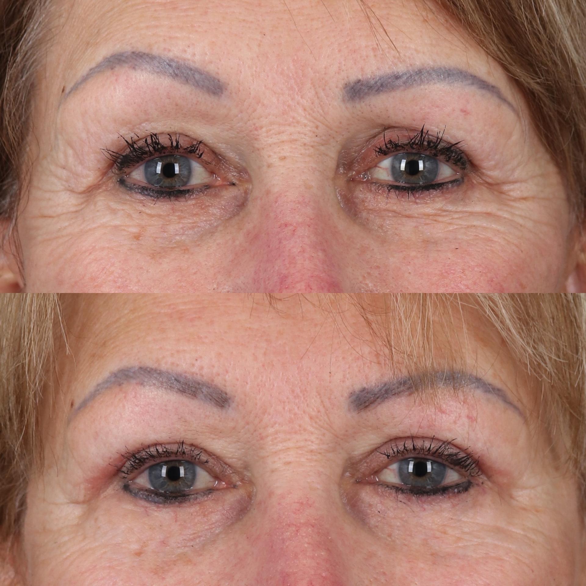 Portland Face Doctor (Peter Vila, MD) eyelid lift result — Tigard, OR