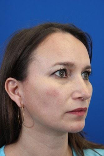 Eric J. Yavrouian, MD rhinoplasty after — Glendale, CA