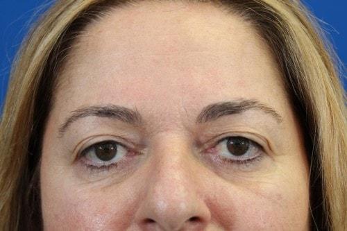 Blepharoplasty before at Eric J. Yavrouian, MD in Glendale, CA