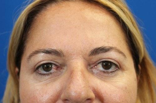 Eric J. Yavrouian, MD eyelid lift after — Glendale, CA