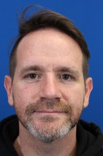 Eric J. Yavrouian, MD rhinoplasty after — Glendale, CA