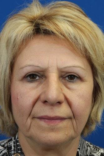 Eric J. Yavrouian, MD rhinoplasty after — Glendale, CA