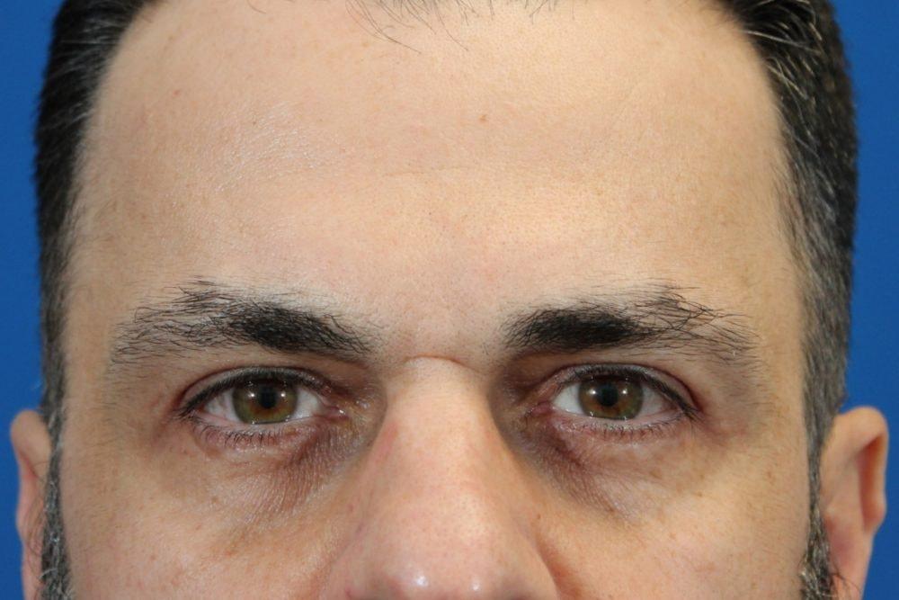 Eric J. Yavrouian, MD eyelid lift after — Glendale, CA