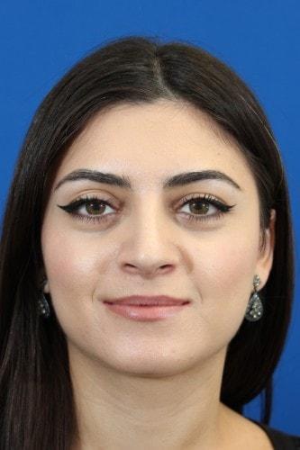 Eric J. Yavrouian, MD rhinoplasty after — Glendale, CA