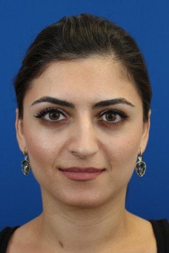 Rhinoplasty before at Eric J. Yavrouian, MD in Glendale, CA