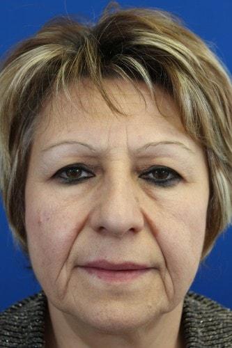 Rhinoplasty before at Eric J. Yavrouian, MD in Glendale, CA