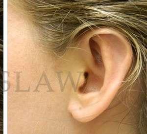 Facelift after at Facelift Conneticut: Dr. Paul Stanislaw in Avon, CT