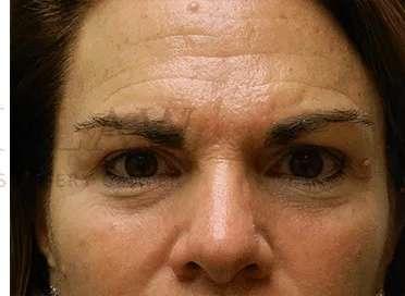 Facelift after at Facelift Conneticut: Dr. Paul Stanislaw in Avon, CT