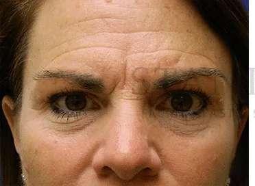 Facelift before at Facelift Conneticut: Dr. Paul Stanislaw in Avon, CT