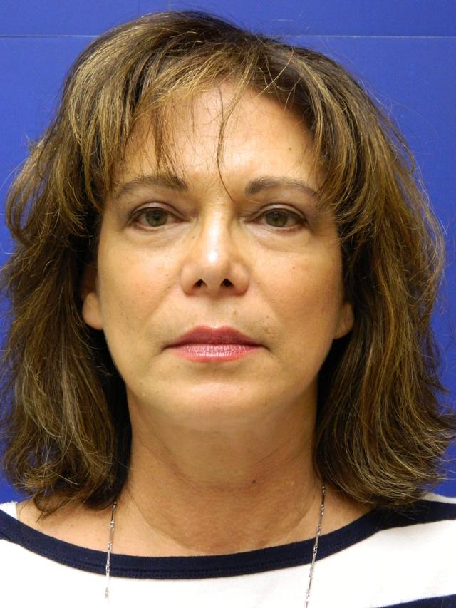 Facelift after at Facelift Conneticut: Dr. Paul Stanislaw in Avon, CT