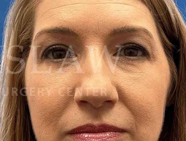 Blepharoplasty after at Facelift Conneticut: Dr. Paul Stanislaw in Avon, CT