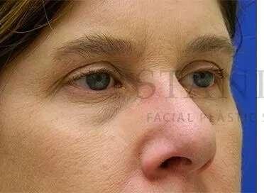 Lip Filler before at Facelift Conneticut: Dr. Paul Stanislaw in Avon, CT