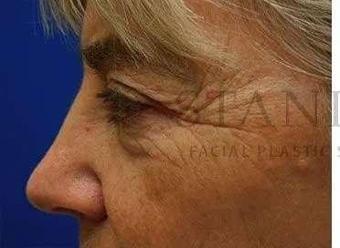 Chemical Peel before at Facelift Conneticut: Dr. Paul Stanislaw in Avon, CT