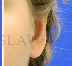Facelift Conneticut: Dr. Paul Stanislaw facelift after — Avon, CT