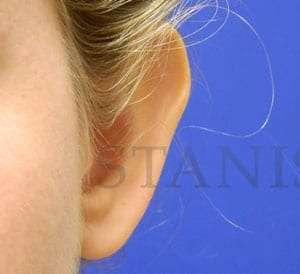 Facelift before at Facelift Conneticut: Dr. Paul Stanislaw in Avon, CT