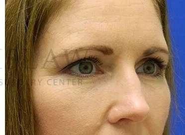 Lip Filler after at Facelift Conneticut: Dr. Paul Stanislaw in Avon, CT