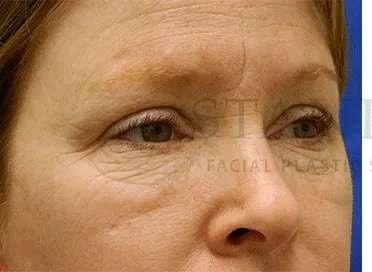 Chemical Peel before at Facelift Conneticut: Dr. Paul Stanislaw in Avon, CT