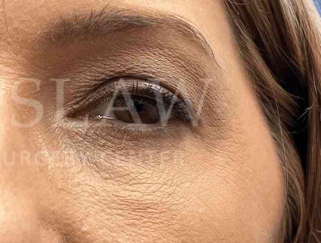 Blepharoplasty after at Facelift Conneticut: Dr. Paul Stanislaw in Avon, CT