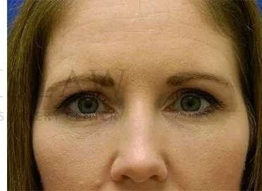 Lip Filler after at Facelift Conneticut: Dr. Paul Stanislaw in Avon, CT