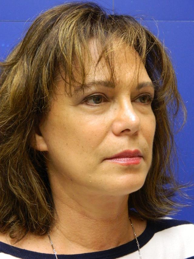 Facelift after at Facelift Conneticut: Dr. Paul Stanislaw in Avon, CT